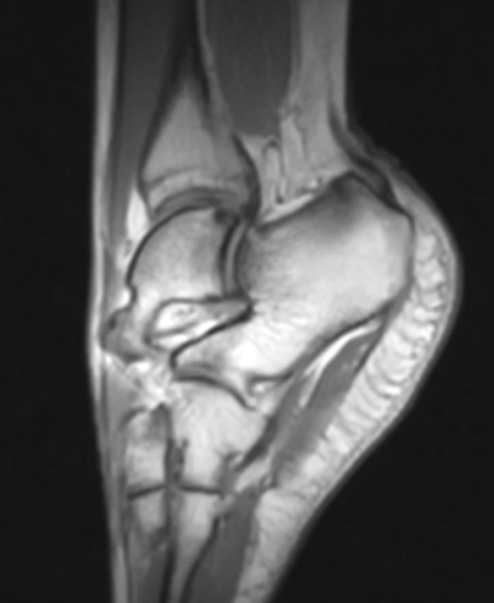 Stress fracture